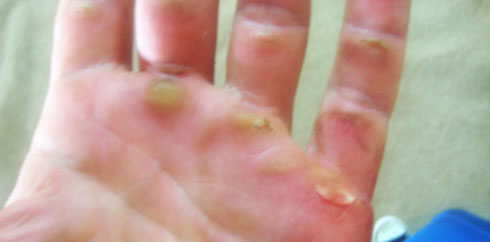 ripped-callus.jpg